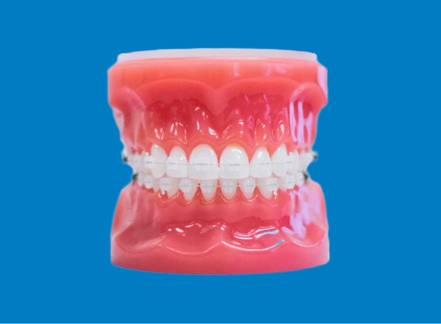 clear braces on plastic model