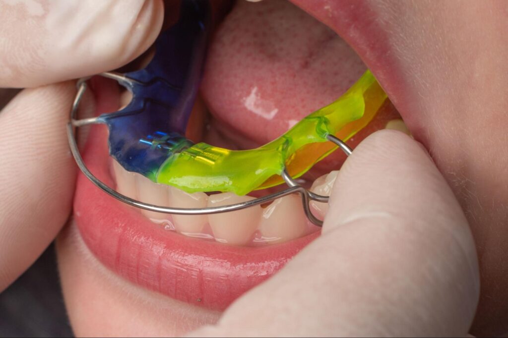 Why Cleaning and Caring for a Retainer is Important